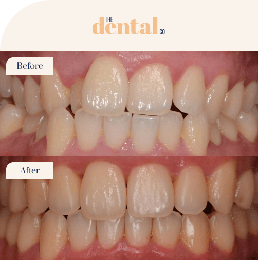 beforeandafter-invisalign2