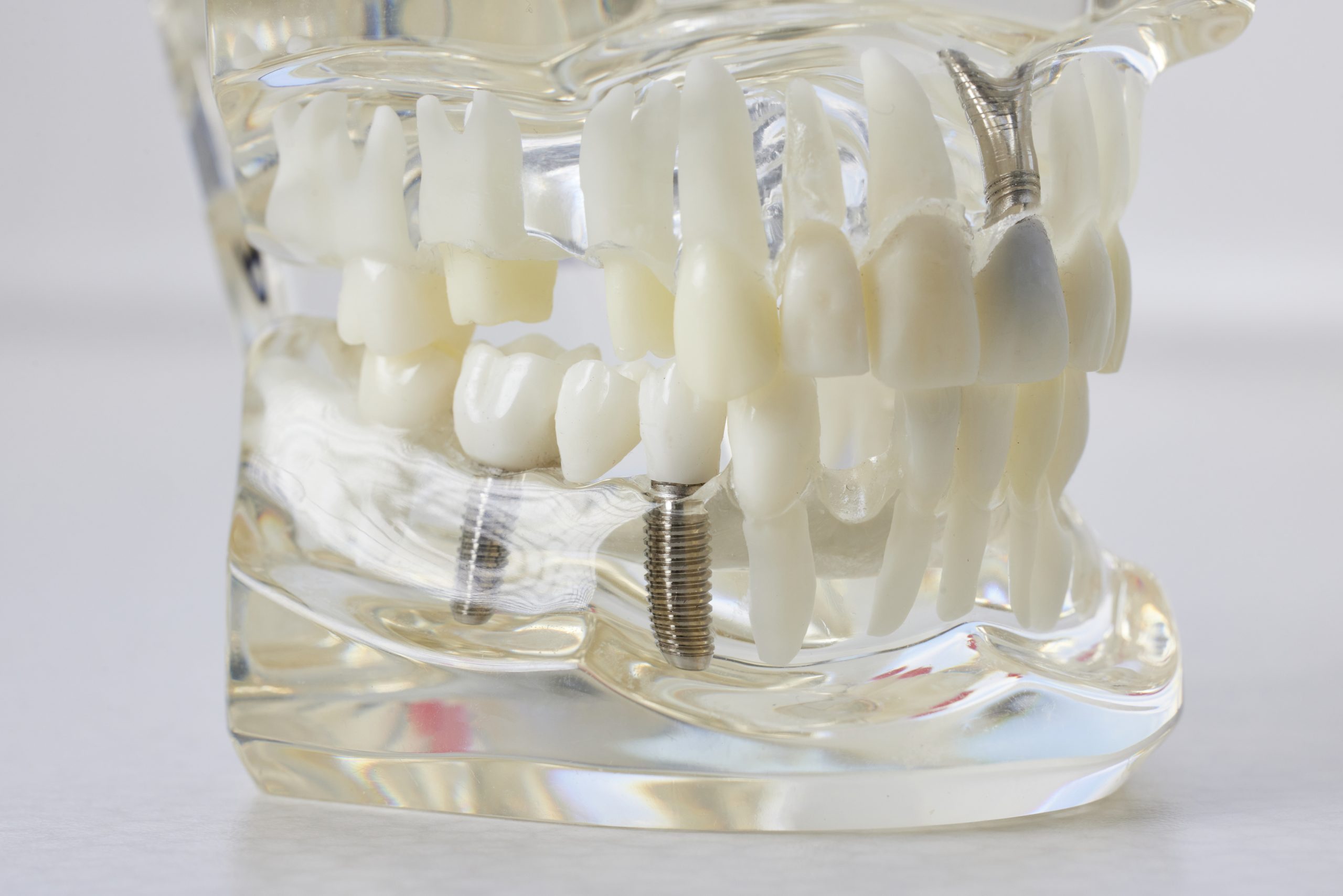 Dental Implants