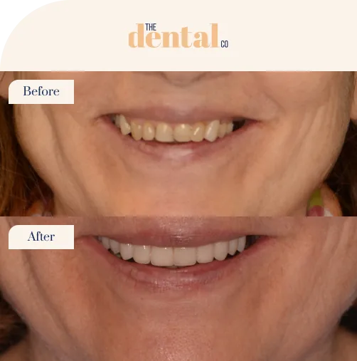 Full Mouth Rehabilitation