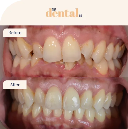 Invisalign