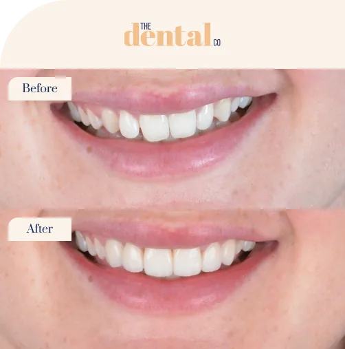 Veneers
